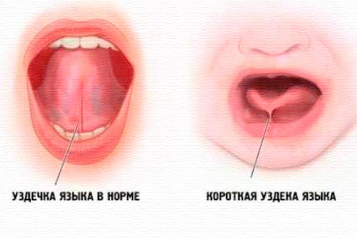 Короткая подъязычная связка