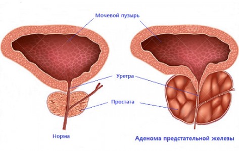 Аденома простаты