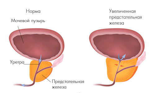 Доброкачественная гиперплазия предстательной железы Доброкачественная гиперплазия предстательной железы