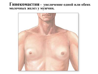 Гинекомастия Гинекомастия