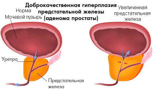 Гиперплазия предстательной железы Гиперплазия предстательной железы