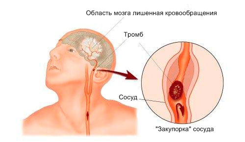 Ишемический инсульт Ишемический инсульт
