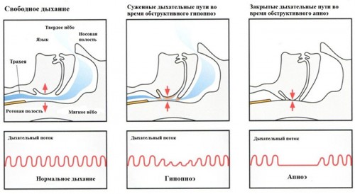 Нарушение дыхания во сне Нарушение дыхания во сне