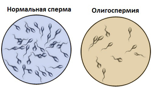 Олигоспермия