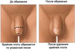 Описание обрезания новорожденного Описание обрезания новорожденного