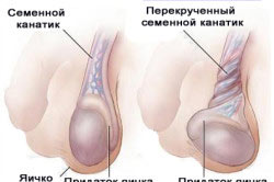 Перекрученный семенной канатик Перекрученный семенной канатик