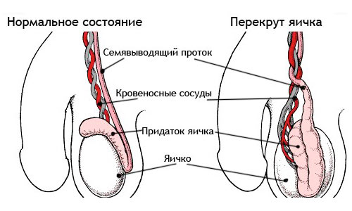 Перекрут яичка Перекрут яичка