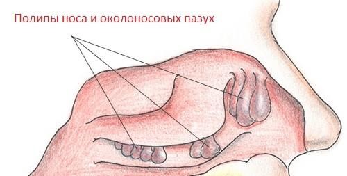 Полипы носа и пазух Полипы носа и пазух