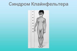 Признаки синдрома Клайнфельтера Признаки синдрома Клайнфельтера