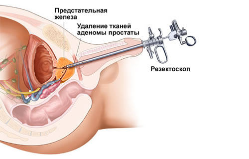 Схема удаления тканевой аденомы простаты Схема удаления тканевой аденомы простаты