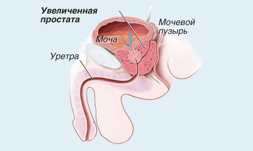 Схема воспаления простаты Схема воспаления простаты