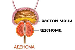 Аденома Аденома