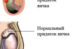 Эпидидимит Эпидидимит