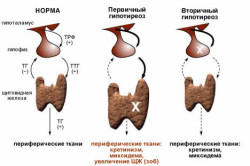 Формы гипертиреоза Формы гипертиреоза