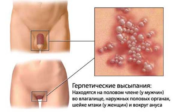 Герпетические высыпания Герпетические высыпания