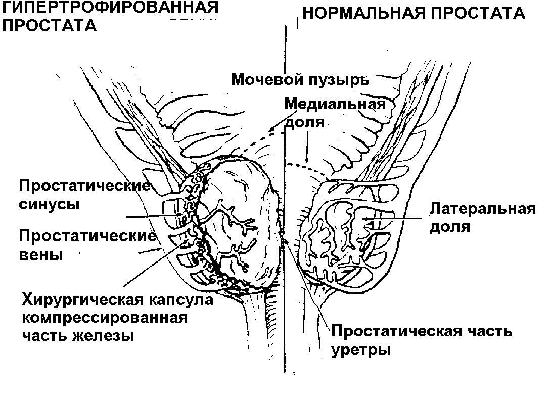 Нормальная и гипертрофированная простата Нормальная и гипертрофированная простата