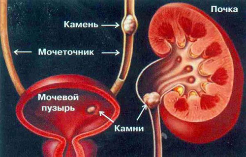 Камни в мочеточнике, мочевом пузыре и почках Камни в мочеточнике, мочевом пузыре и почках