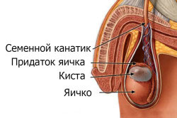 Киста придатка яичка Киста придатка яичка
