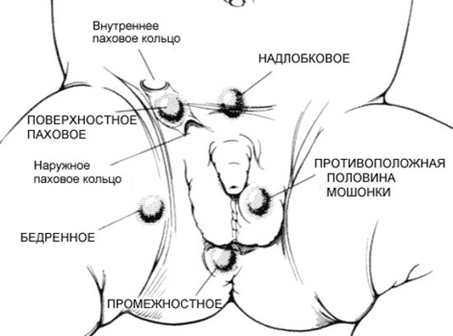 Возможное положение яичка при крипторхизме Возможное положение яичка при крипторхизме