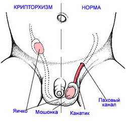 Втягивающееся яичко Втягивающееся яичко
