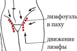 Воспаление лимфоузлов в паху Воспаление лимфоузлов в паху