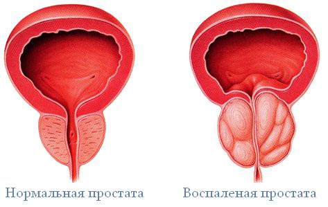Признаки простатита острой бактериальной формы Признаки простатита острой бактериальной формы