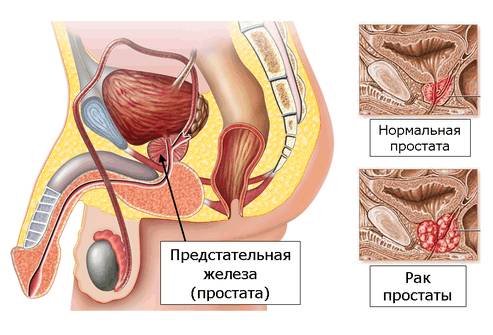 Рисунок 1. Распространение рака в соединительные ткани и органы. Рисунок 1. Распространение рака в соединительные ткани и органы.
