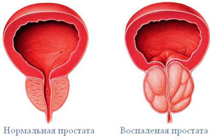 Воспаление простаты Воспаление простаты