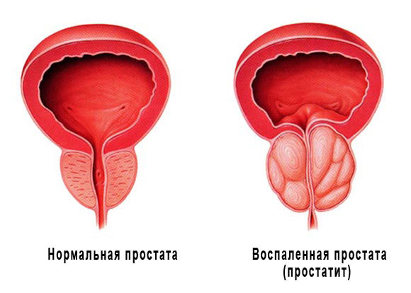 Возможные проблемы с простатой при длительном разжижении спермы Возможные проблемы с простатой при длительном разжижении спермы