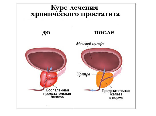 Лечение простатита Лечение простатита