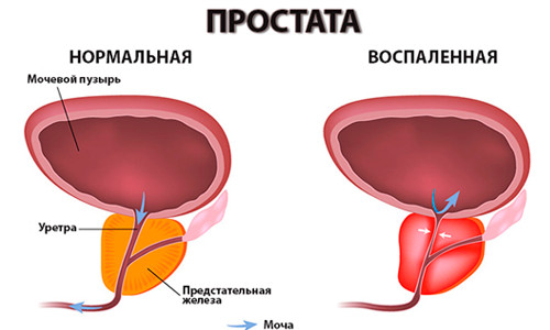 Простатит Простатит