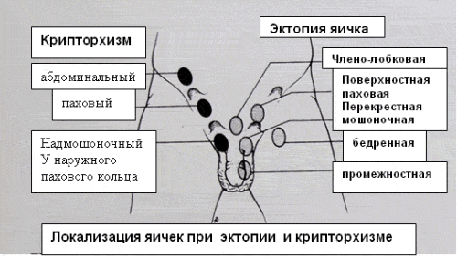 Крипторхизм - результат остановки яичка на каком-либо этапе опускания по нормальному пути Крипторхизм - результат остановки яичка на каком-либо этапе опускания по нормальному пути