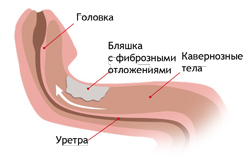 Схема кисты яичка Схема кисты яичка