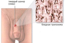 Начальный этап сифилиса Начальный этап сифилиса